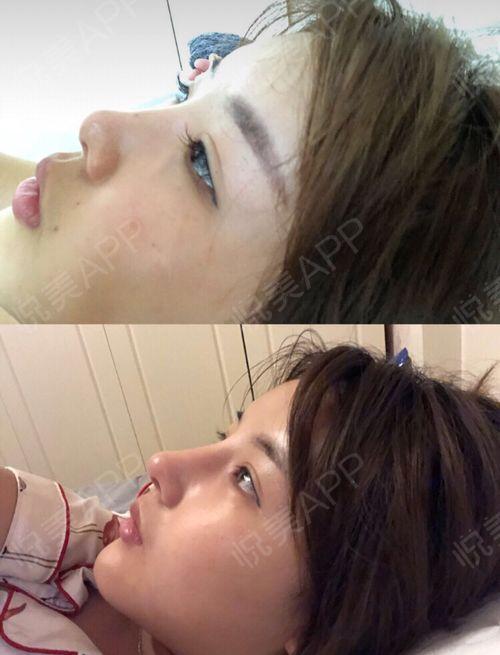 杭州异骨鼻网红